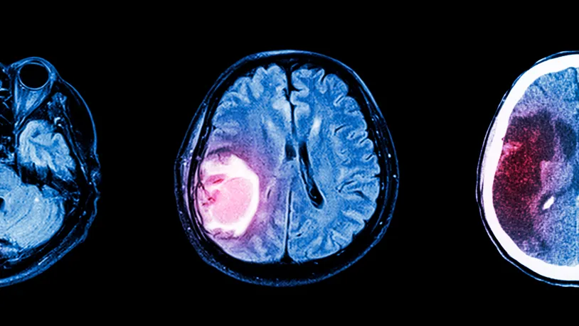 Tumor Cerebral